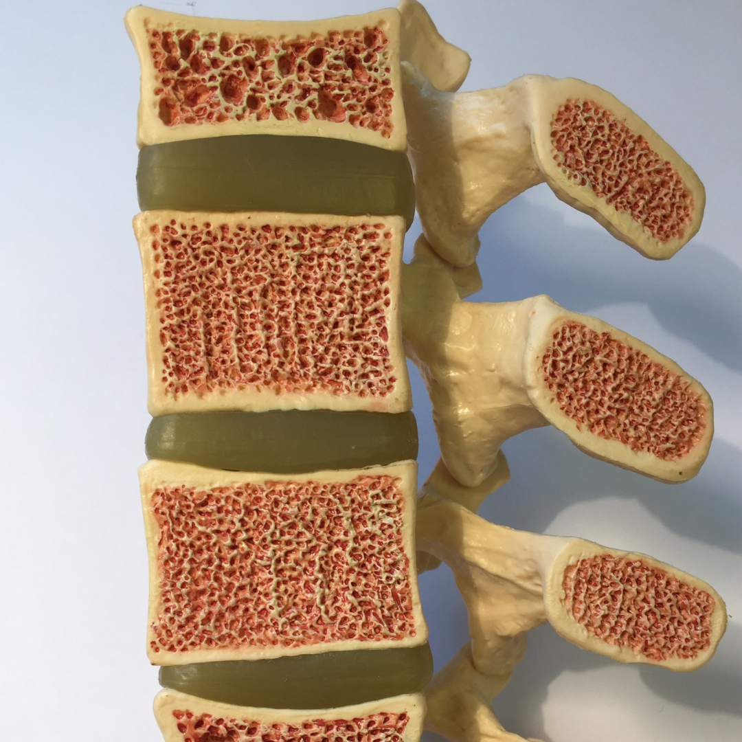 model showing osteoporosis